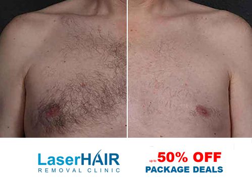 best laser hair removal Toronto