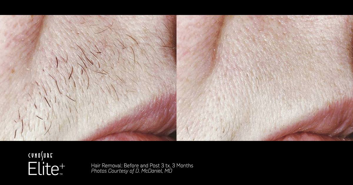 does laser hair removal work Toronto