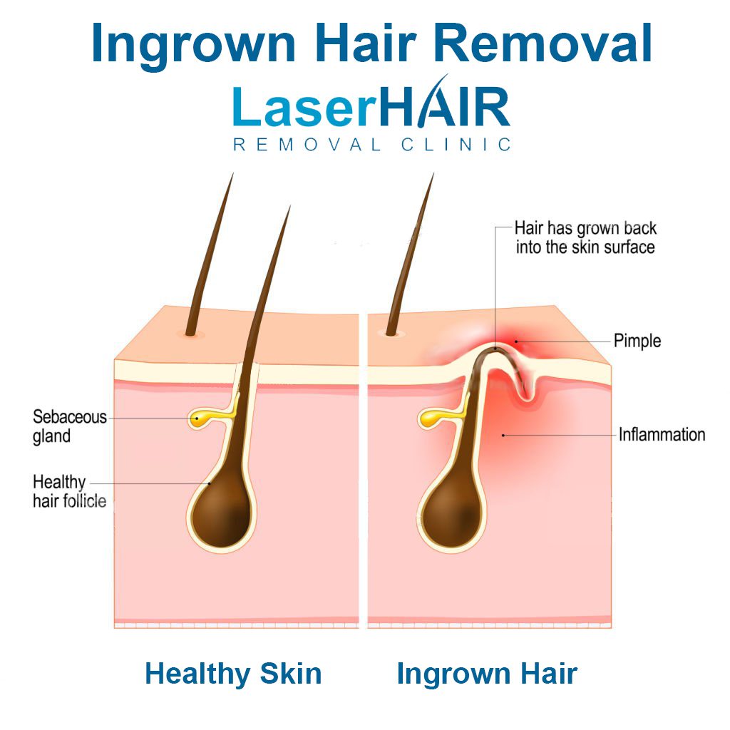 ingrown-hair-removal