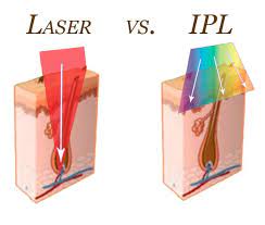 laser vs ipl