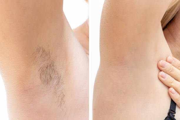 Laser Hair Removal – All Your Questions Answered