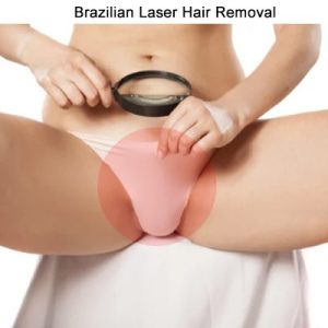 Brazilian-laser-hair-removal